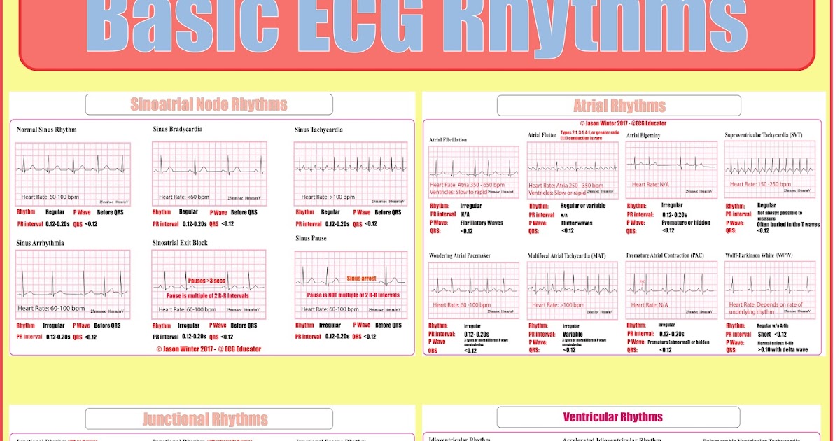 Basic Ekg Rhythm Strips Printable